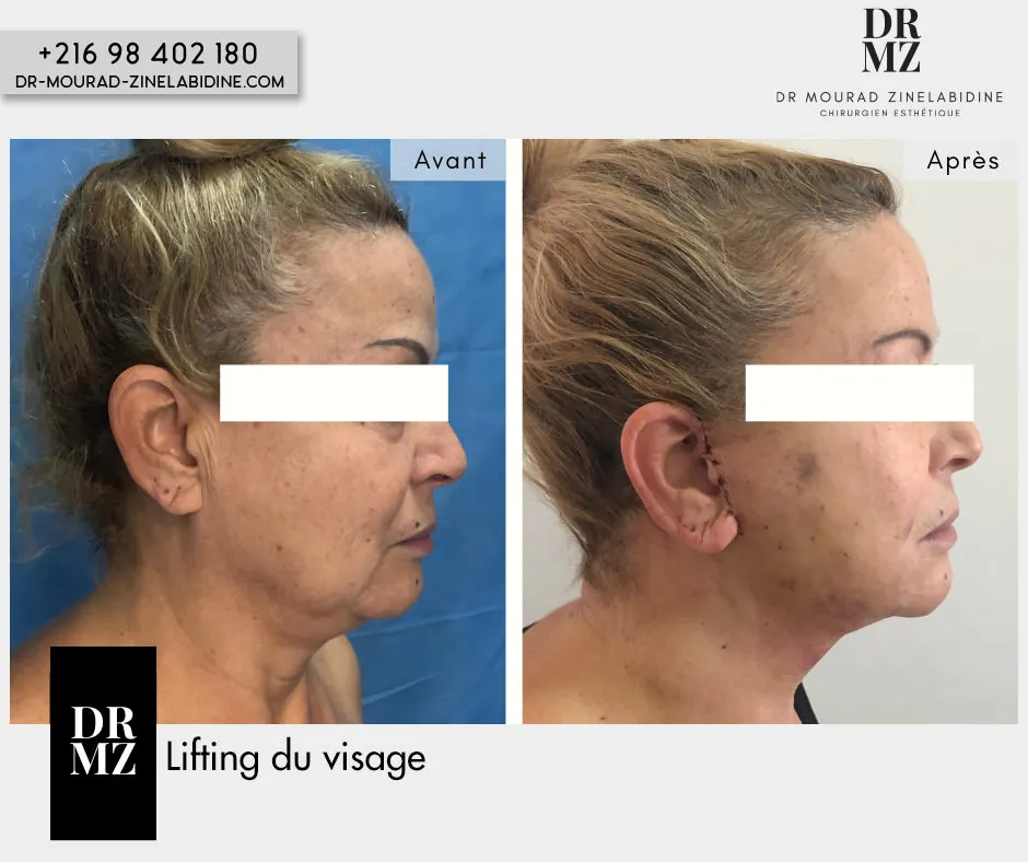 Photo avant & après lifting du visage