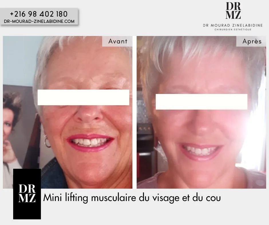 Photo avant & après lifting du visage