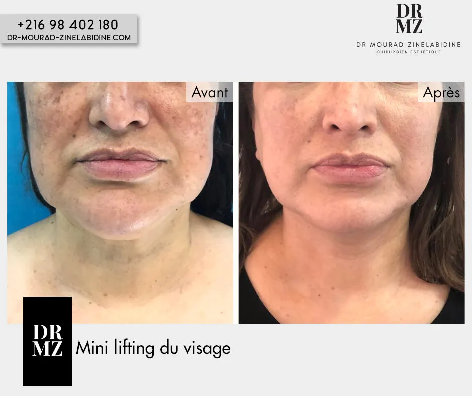 Photo avant & après lifting du visage