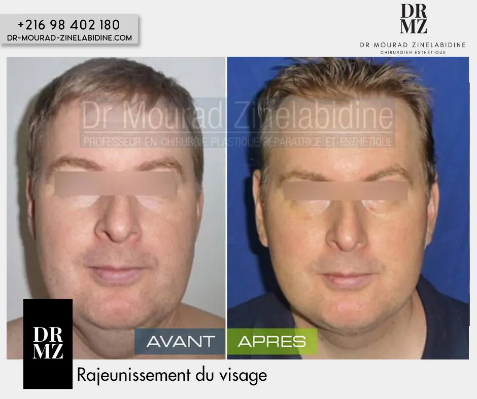 Photo avant & après lifting du visage