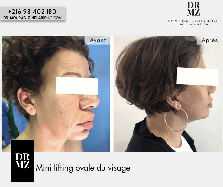 Photo avant & après lifting du visage