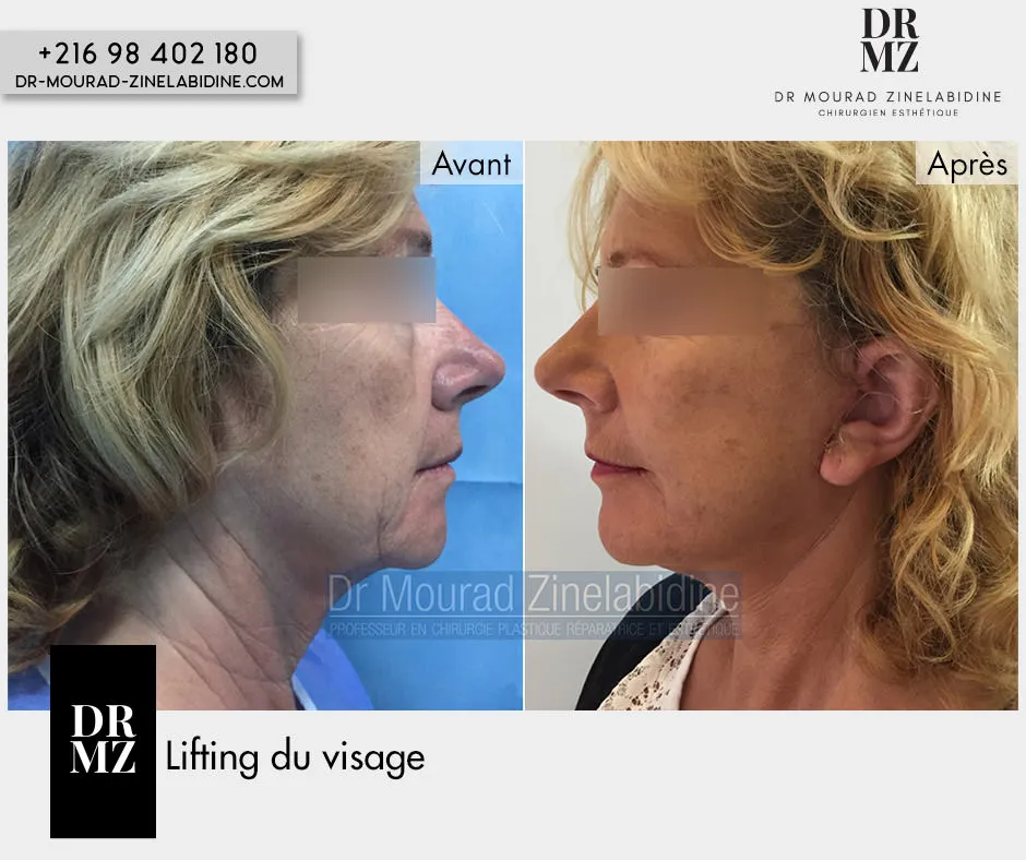 Photo avant & après lifting du visage