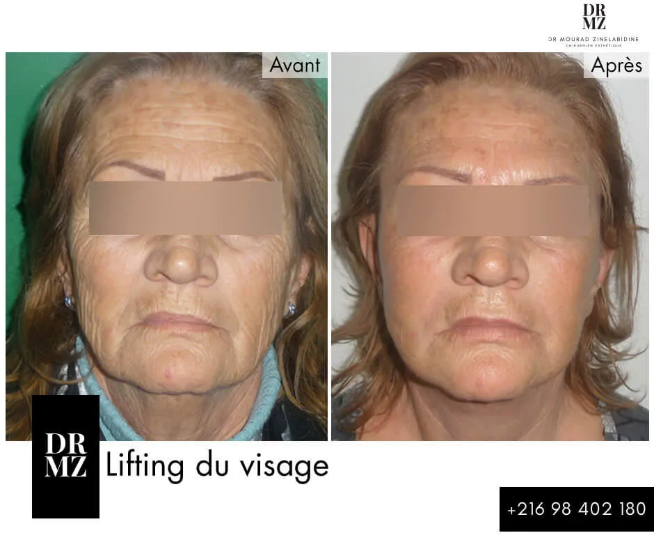 Photo avant & après lifting du visage