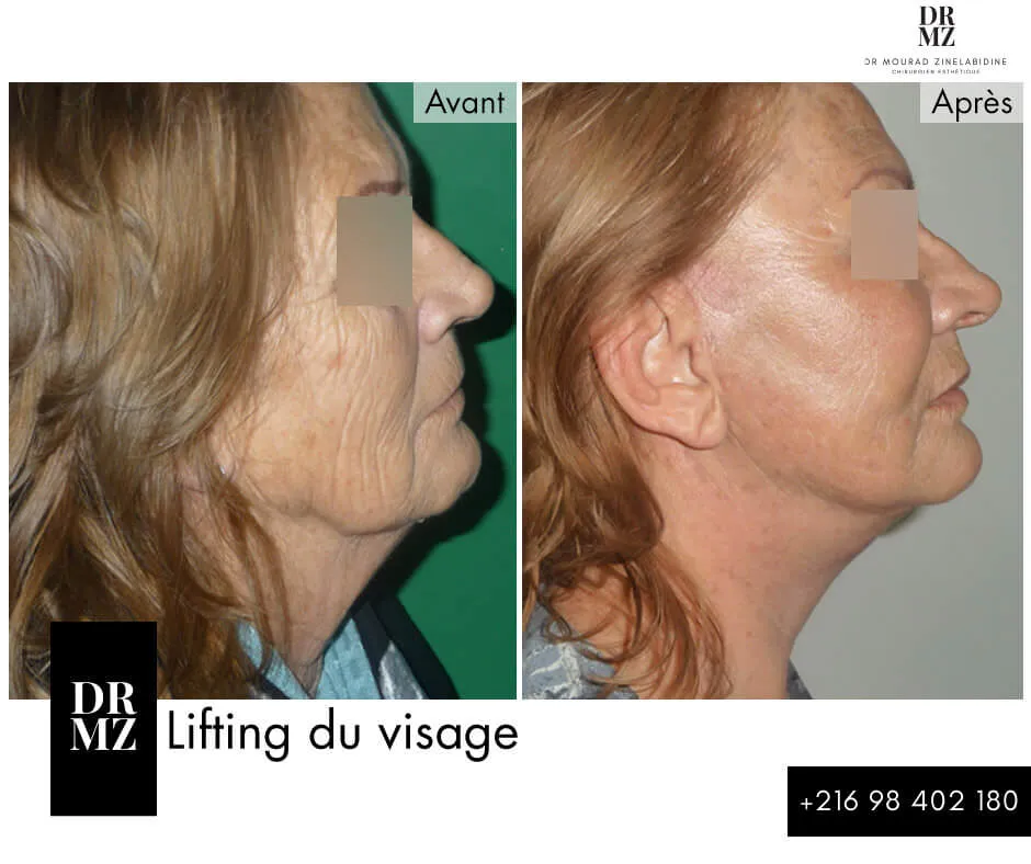 Photo avant & après lifting du visage