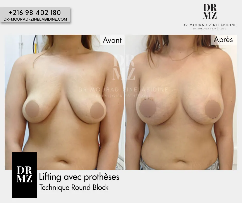 Photo avant & après lifting mammaire avec prothèses Tunisie