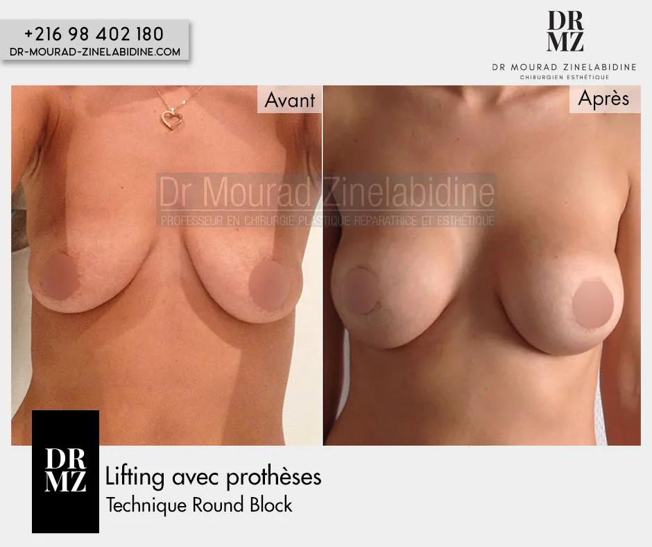 Photo avant & après lifting mammaire avec prothèses Tunisie