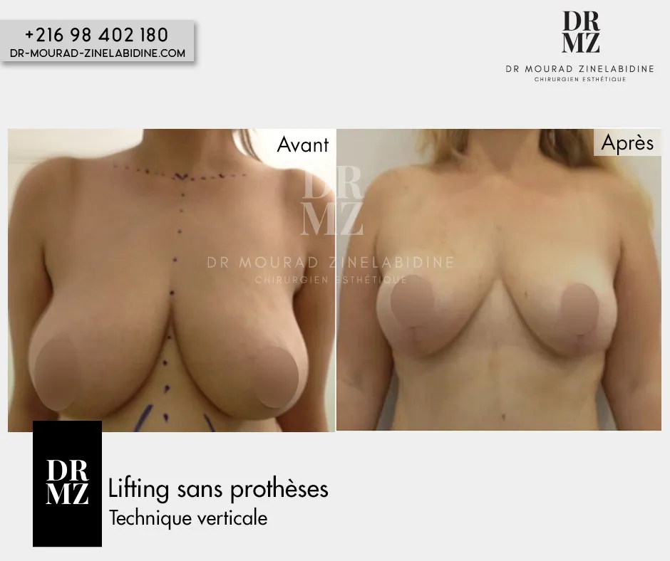 Photo avant & après lifting mammaire sans prothèses Tunisie