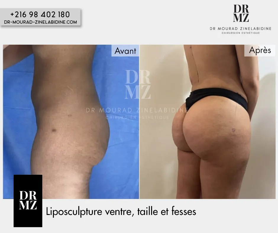 Photo avant & après lipofilling fesses Tunisie