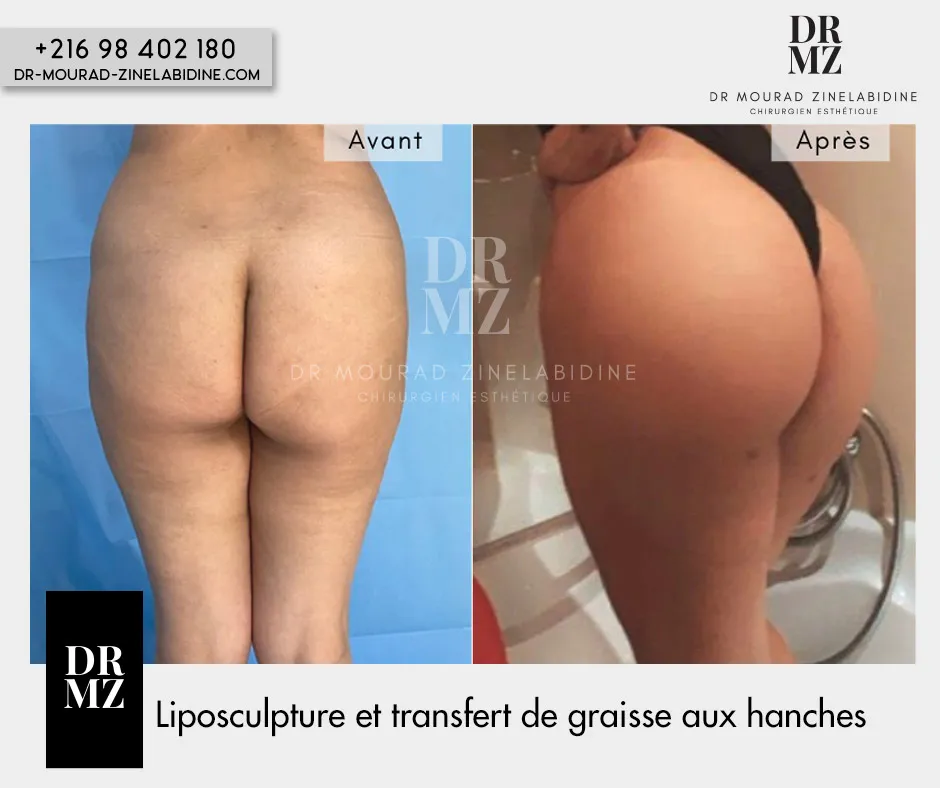 Photo avant & après lipofilling fesses Tunisie