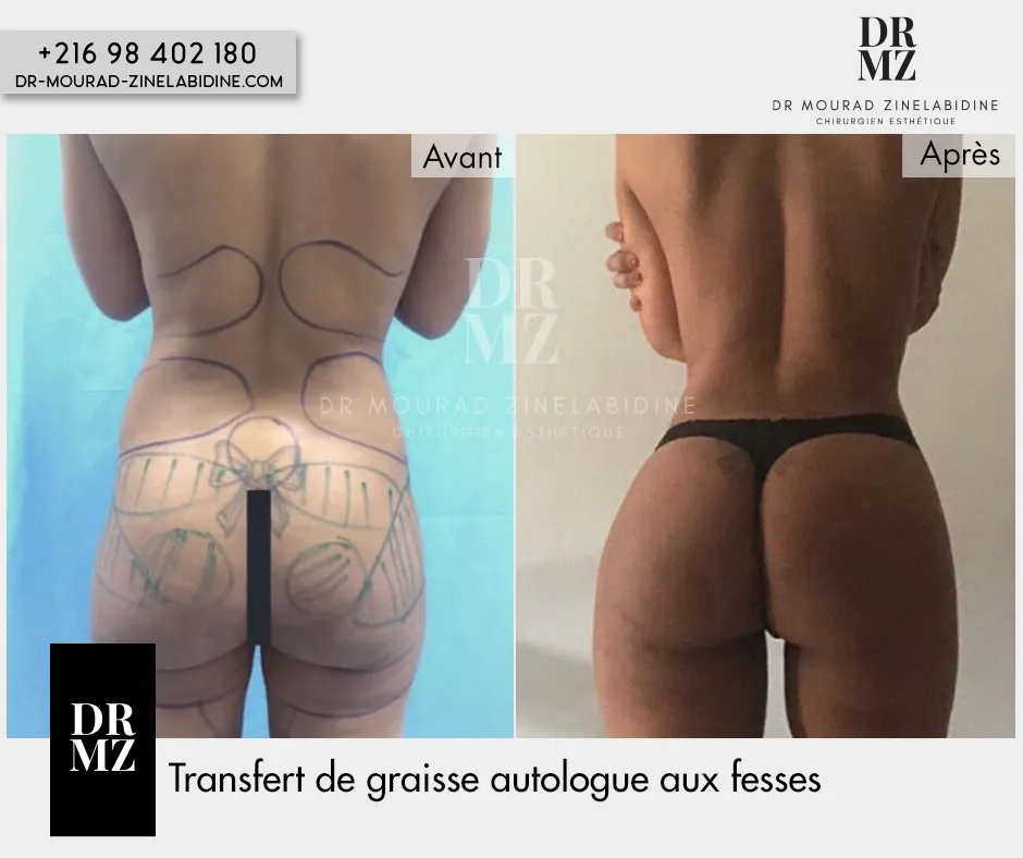 Photo avant & après lipofilling fesses Tunisie