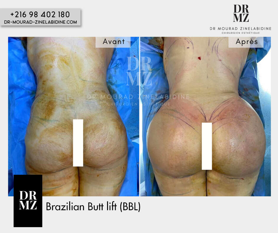 Lipofilling fesses Tunisie