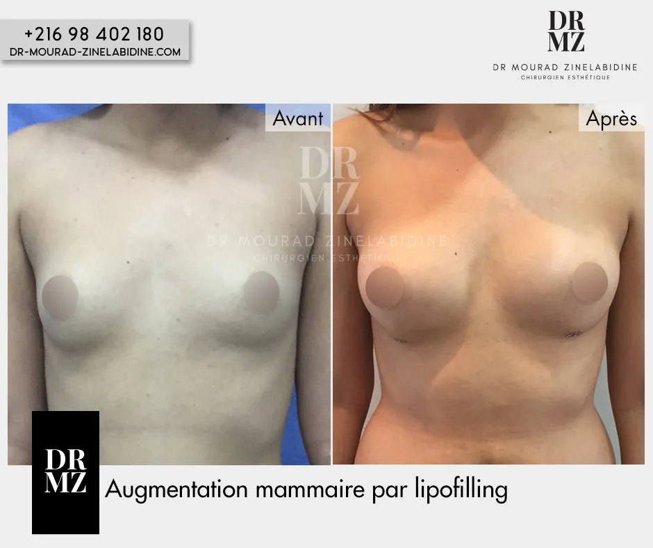 Photo avant & après lipofilling mammaire Tunisie