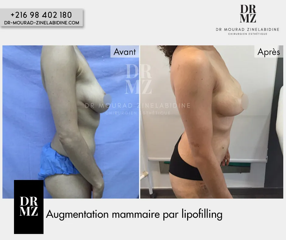 Photo avant & après lipofilling mammaire Tunisie