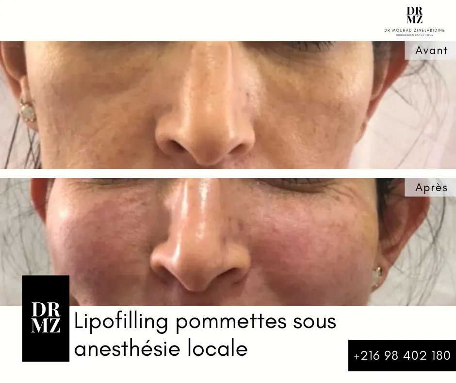 Photo avant & après lipofilling visage Tunisie