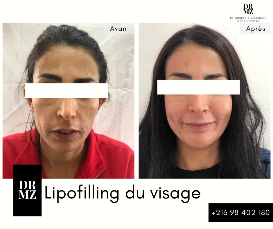 Photo avant & après lipofilling visage Tunisie