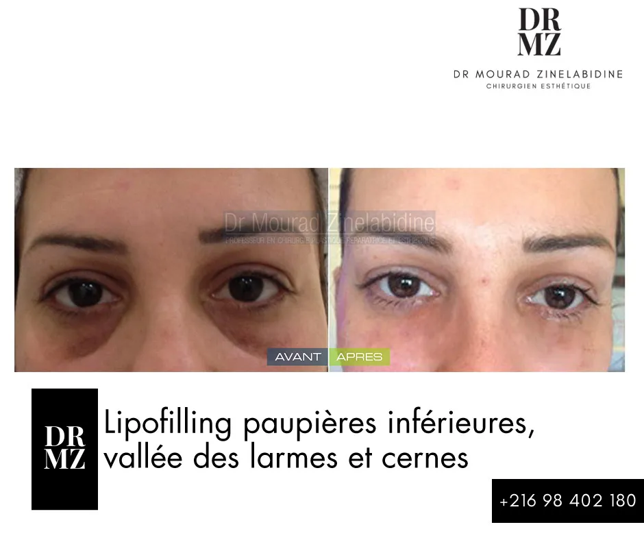 Photo avant & après lipofilling visage Tunisie