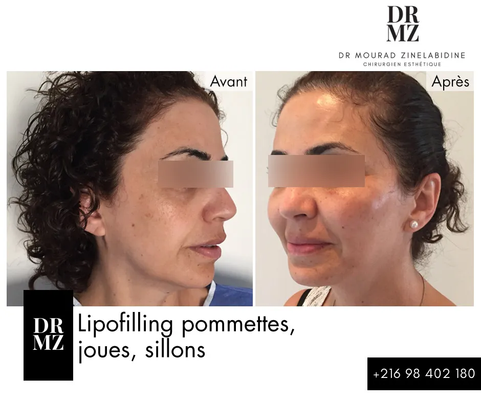 Photo avant & après lipofilling visage Tunisie