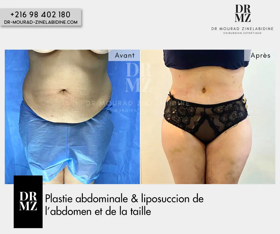 Photo avant & après Abdominoplastie Tunisie