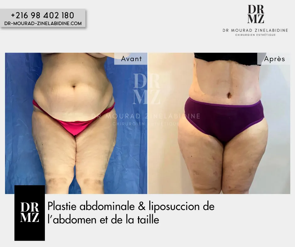 Photo avant & après Abdominoplastie Tunisie