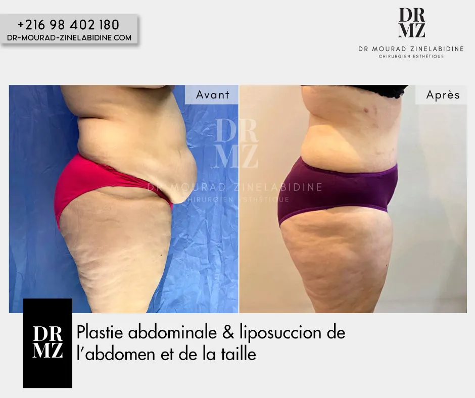Photo avant & après Abdominoplastie Tunisie