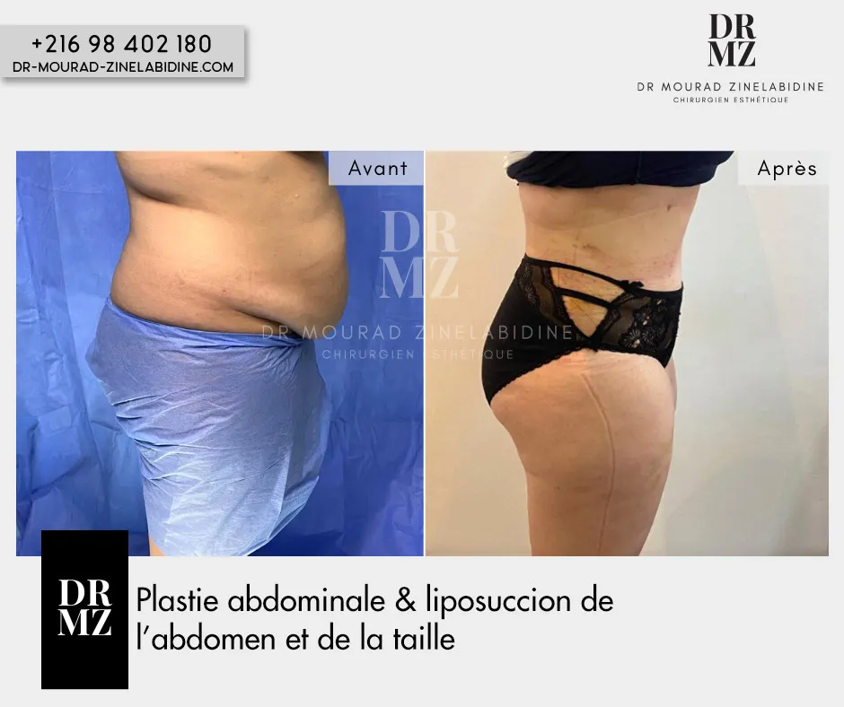 Photo avant & après Abdominoplastie Tunisie