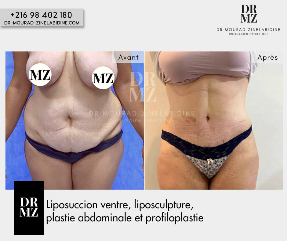 Cas abdominoplastie