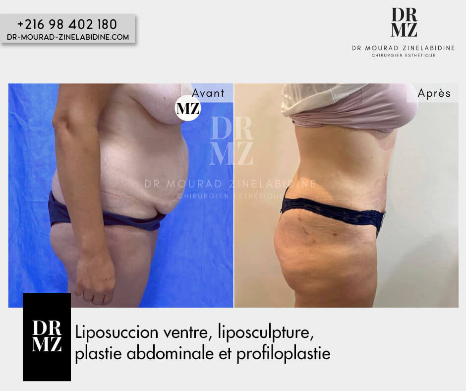 Cas abdominoplastie