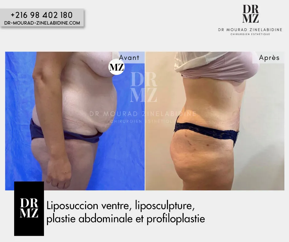 Photo avant & après Abdominoplastie Tunisie