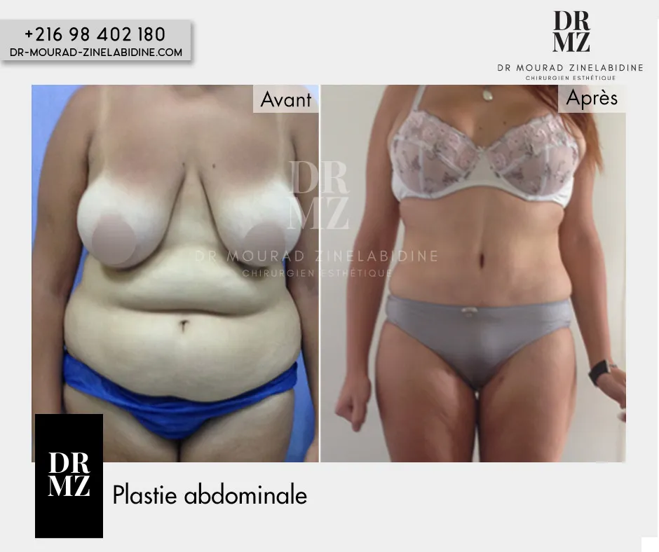 Photo avant & après Abdominoplastie Tunisie