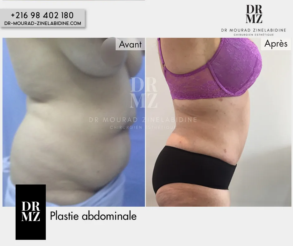 Photo avant & après Abdominoplastie Tunisie