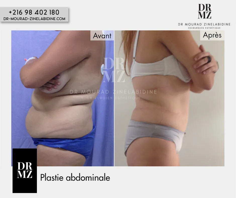 Photo avant & après Abdominoplastie Tunisie