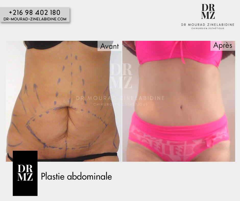 Abdominoplastie Tunisie