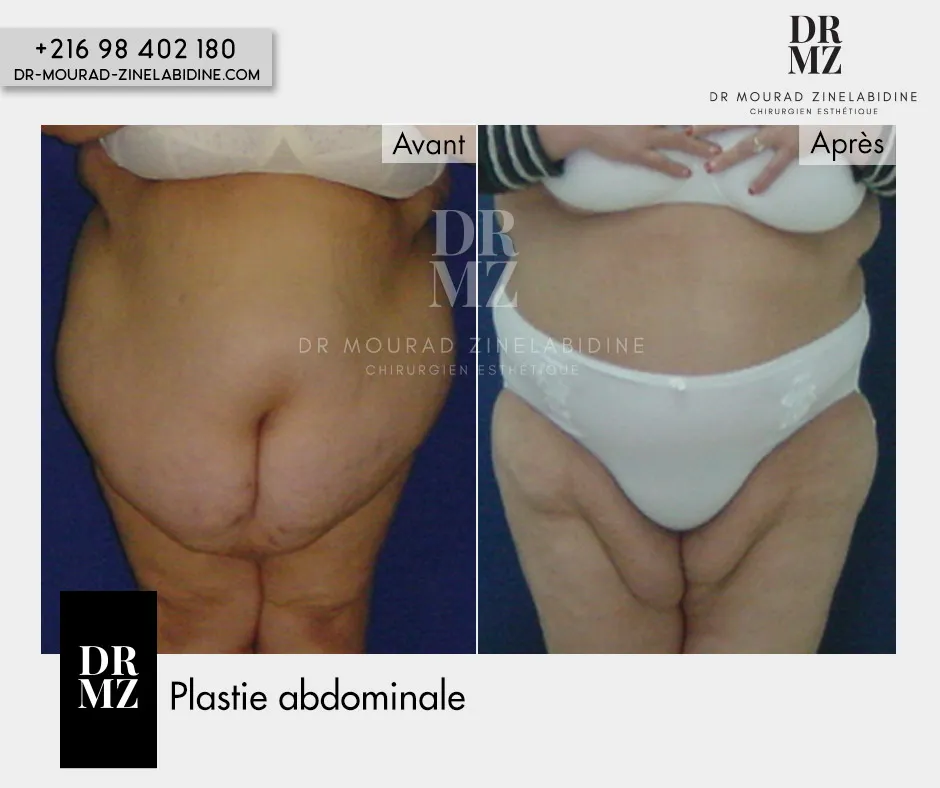 Photo avant & après Abdominoplastie Tunisie