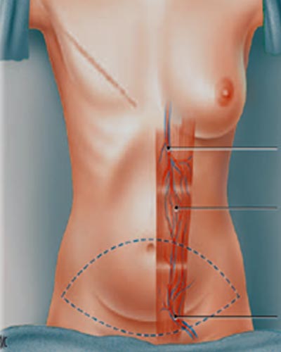 Reconstruction sein CANCER Tunisie