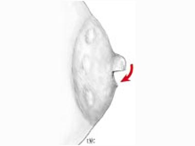 Reconstruction sein CANCER Tunisie