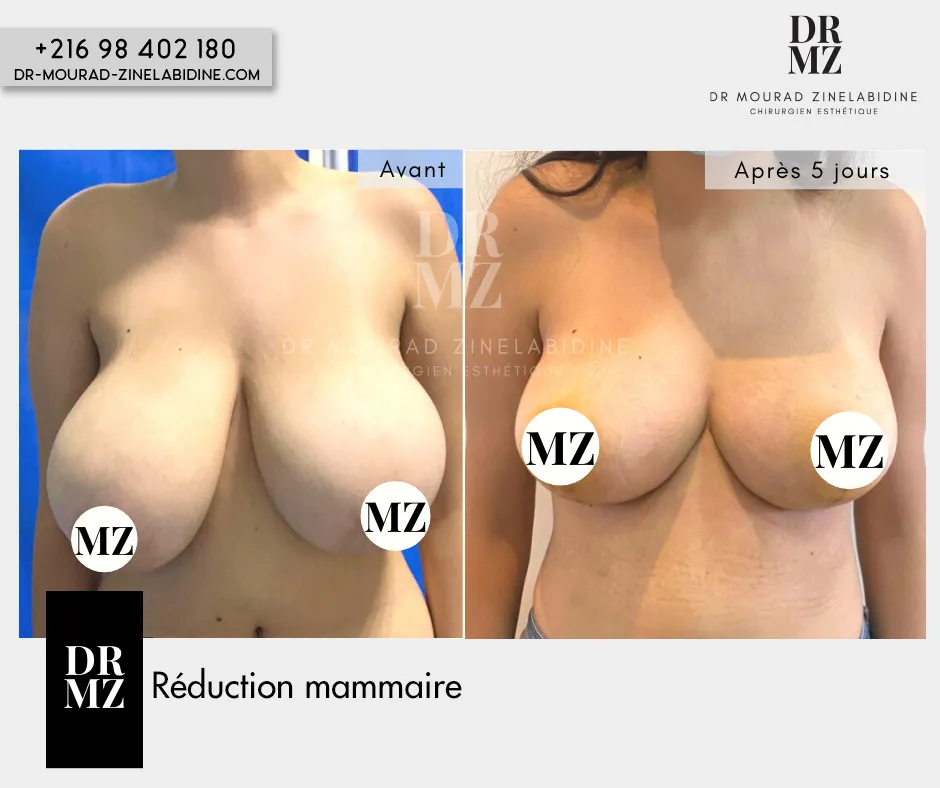 Photo avant & après reduction mammaire Tunisie