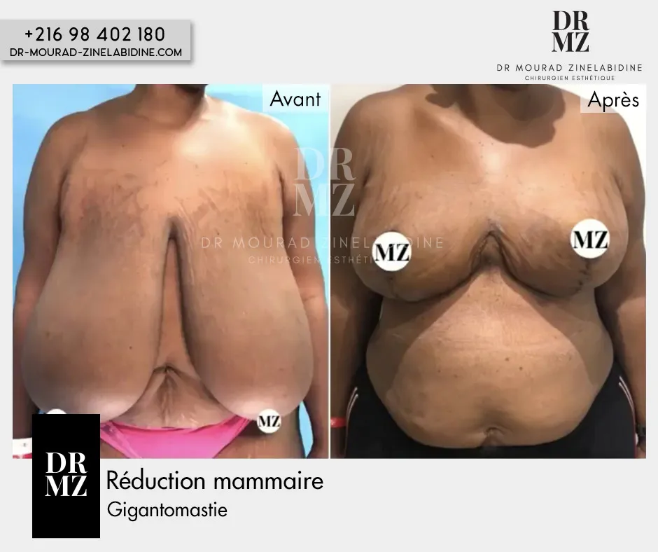 Photo avant & après reduction mammaire Tunisie