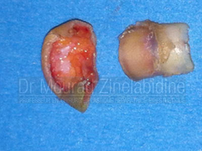 Amputation réimplantation main Tunisie