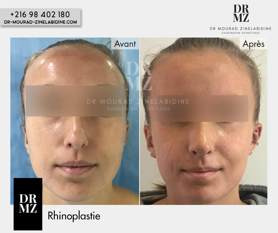 Photo avant & après Rhinoplastie Tunisie