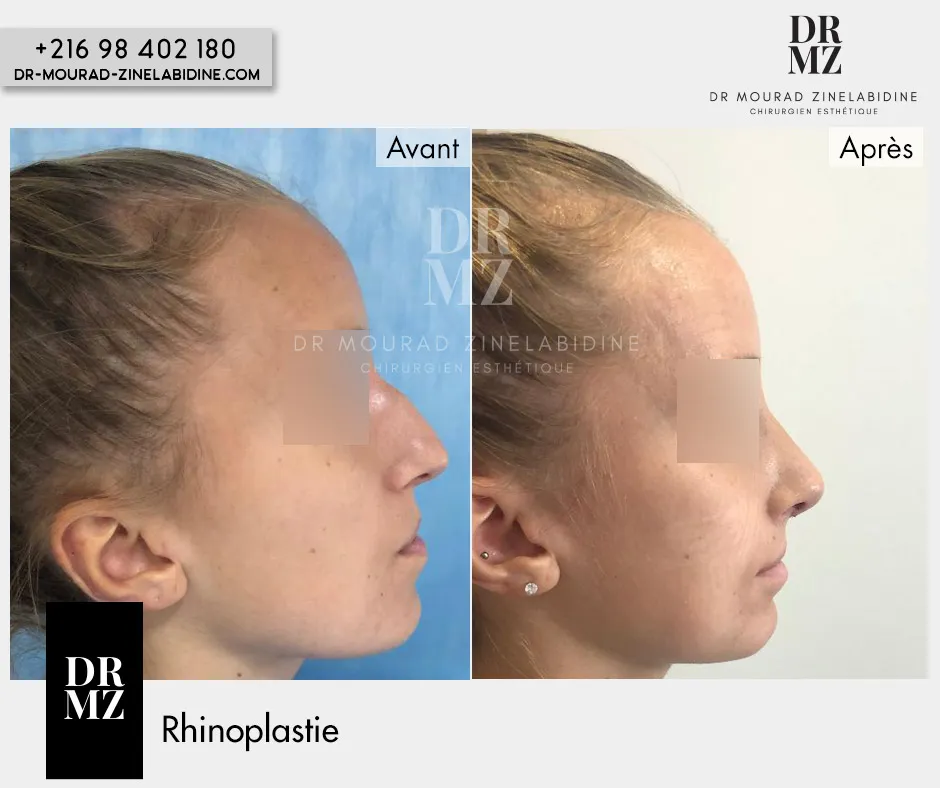 Photo avant & après Rhinoplastie Tunisie