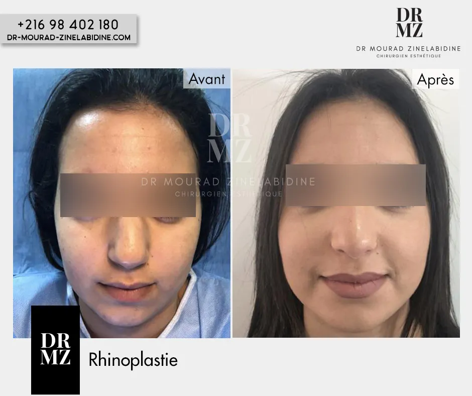 Photo avant & après Rhinoplastie Tunisie