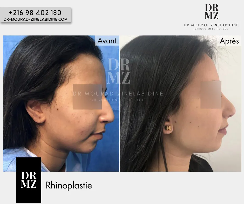 Photo avant & après Rhinoplastie Tunisie