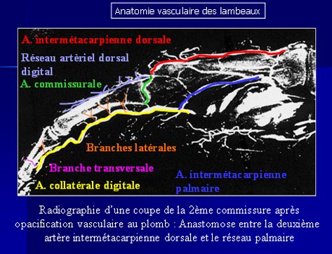 ECRASEMENTS DE LA MAIN