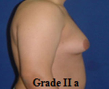 Gynecomastie Tunisie grade 2a