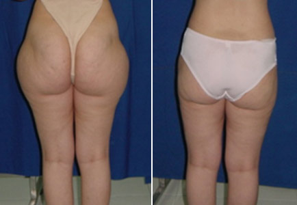 liposuccion, Photo avant et après