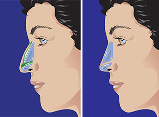 Rhinoplastie de réduction en Tunisie