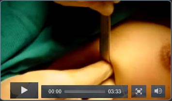 Vidéo prothèse mammaire