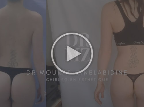 Témoignage chirurgie esthetique tunisie